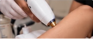 Laser hair removal treatment