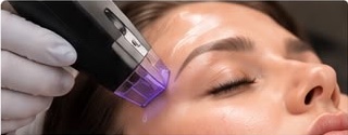 Radiofrequency skin tightening procedure