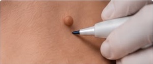 Skin tag removal training demonstration
